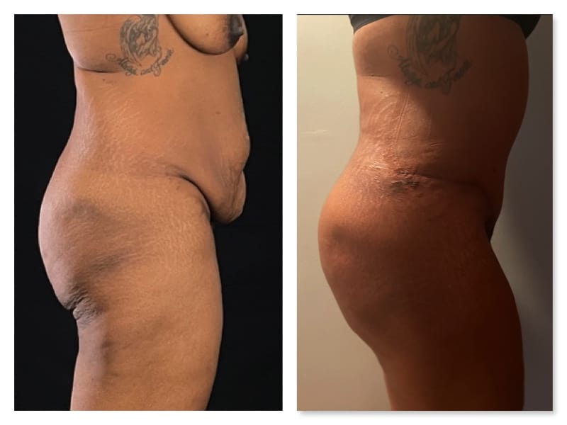 Tummy Tuck Before & After Gallery - Patient 133183894 - Image 4