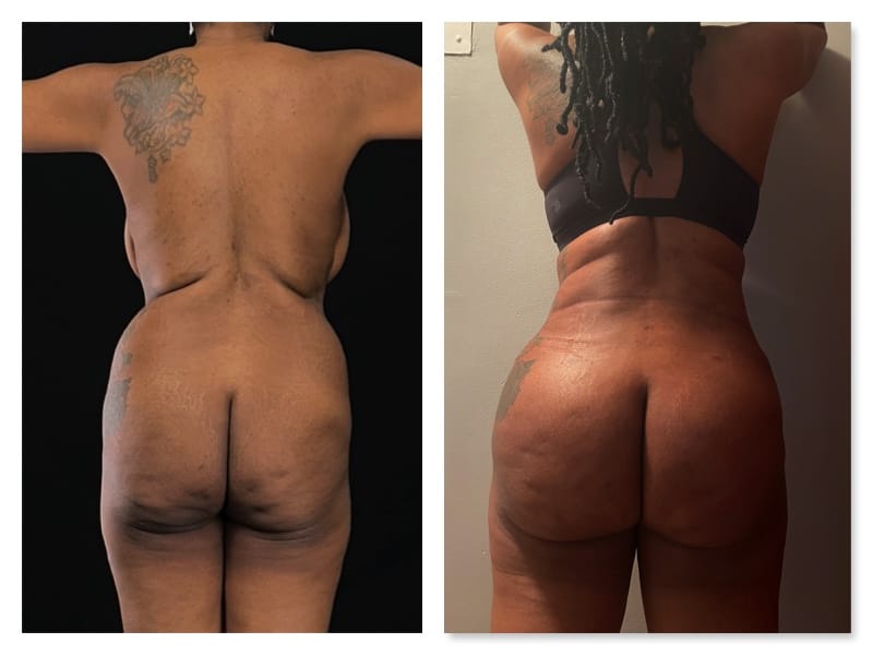 Tummy Tuck Before & After Gallery - Patient 133183894 - Image 2
