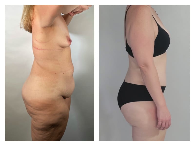 Liposuction Before & After Gallery - Patient 133183636 - Image 4
