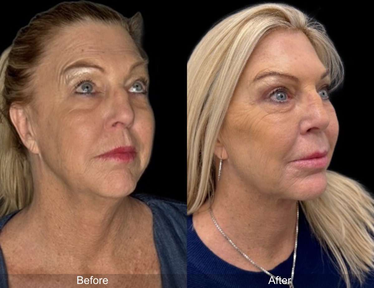 InstaFix Face and Neck before and after
