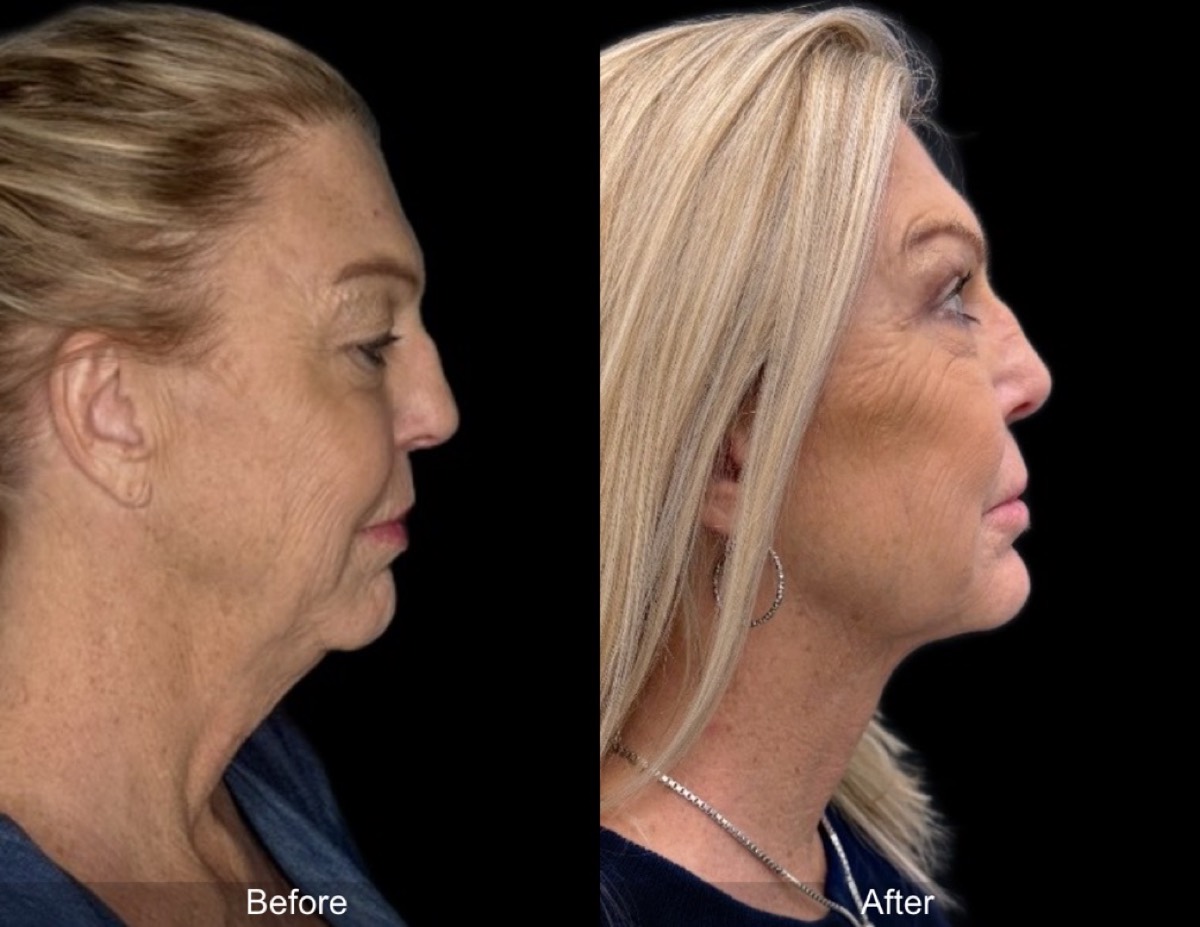 InstaFix Face and Neck before and after &mdash; 59-year-old patient, view 2