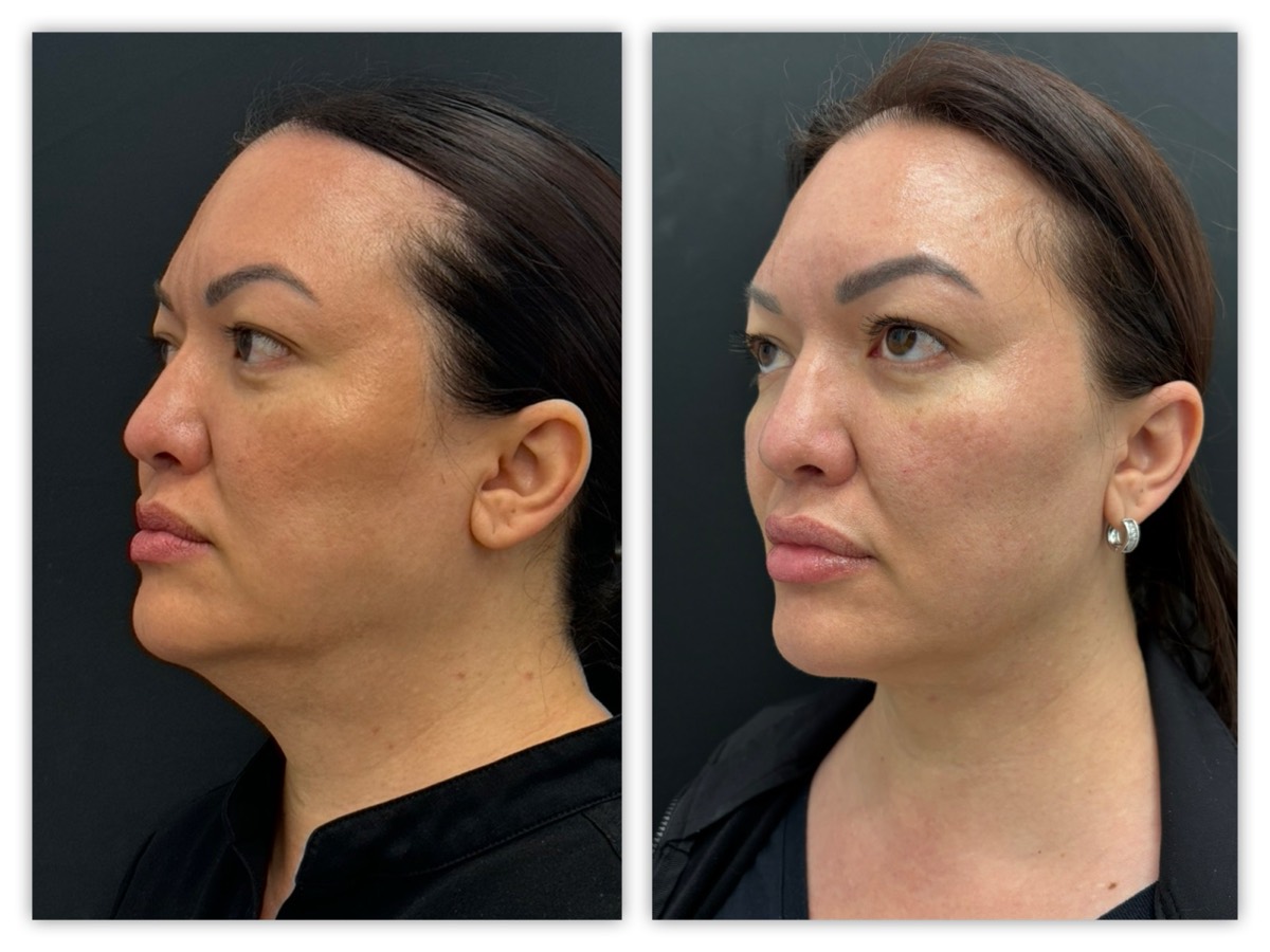 InstaFix Neck contouring before and after &mdash; 45-year-old patient, profile view 2