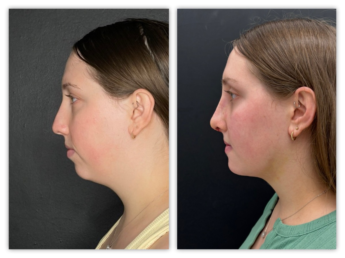 Facial profile refinement before and after &mdash; young patient, view 1