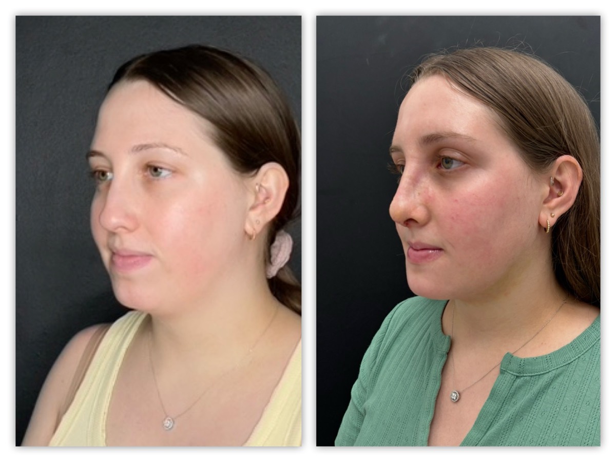 Facial profile refinement before and after &mdash; young patient, view 2